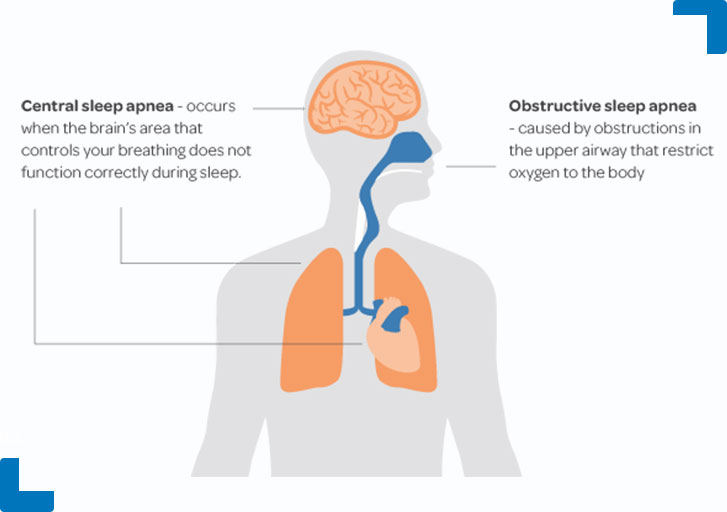 central sleep apnea