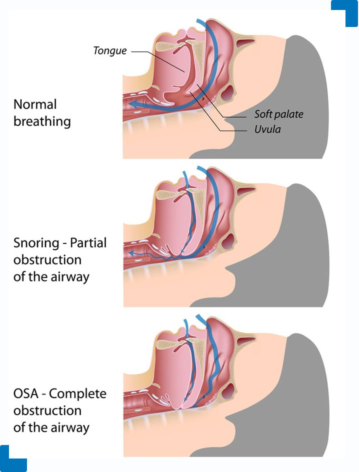 sleep apnea illustration